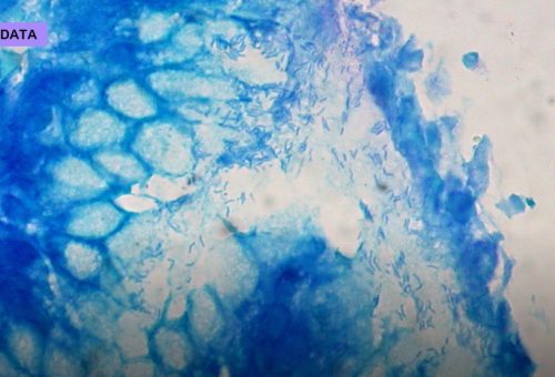 Liquid Biopsies Hunt Cancer in a Blood Draw
