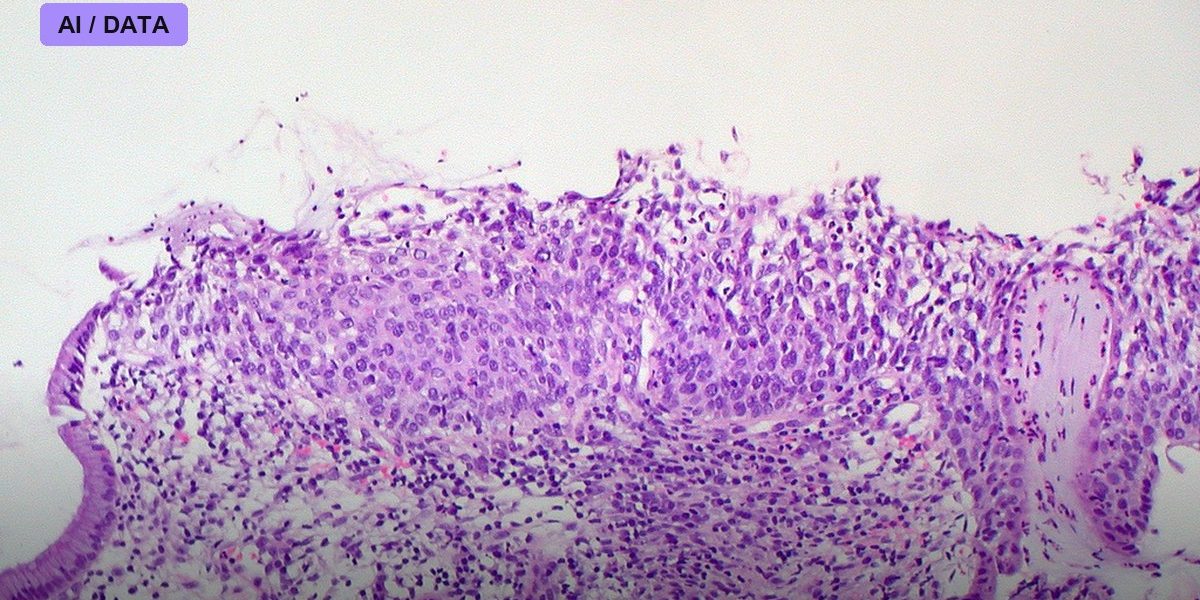 Your Biopsy Slide Can Now Predict Its Own Future — FDA Clears First AI Risk Score for Breast Cancer Pathology