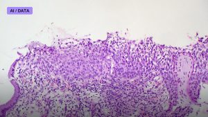 Your Biopsy Slide Can Now Predict Its Own Future — FDA Clears First AI Risk Score for Breast Cancer Pathology