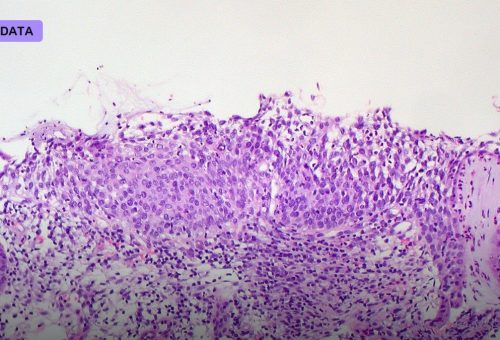 Your Biopsy Slide Can Now Predict Its Own Future — FDA Clears First AI Risk Score for Breast Cancer Pathology