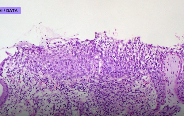 Your Biopsy Slide Can Now Predict Its Own Future — FDA Clears First AI Risk Score for Breast Cancer Pathology