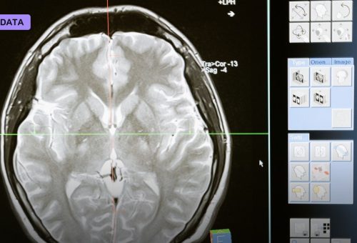 AI Reading Plain CT Scans Catches Stroke Blockages Doctors Miss, Multinational Trial Finds