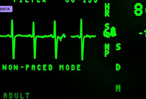 An AI That Reads a Routine ECG Just Got FDA Clearance to Catch a Silent Heart Valve Killer